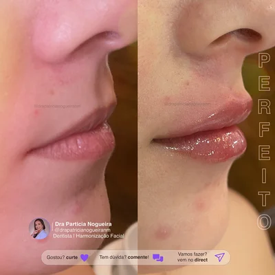 Resultados de preenchimento labial antes e depois