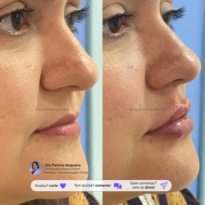 Resultados de preenchimento labial antes e depois